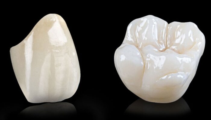 CORONA IN ZIRCONIO