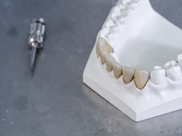 CORONA METALLO CERAMICA SU LASER MELTING